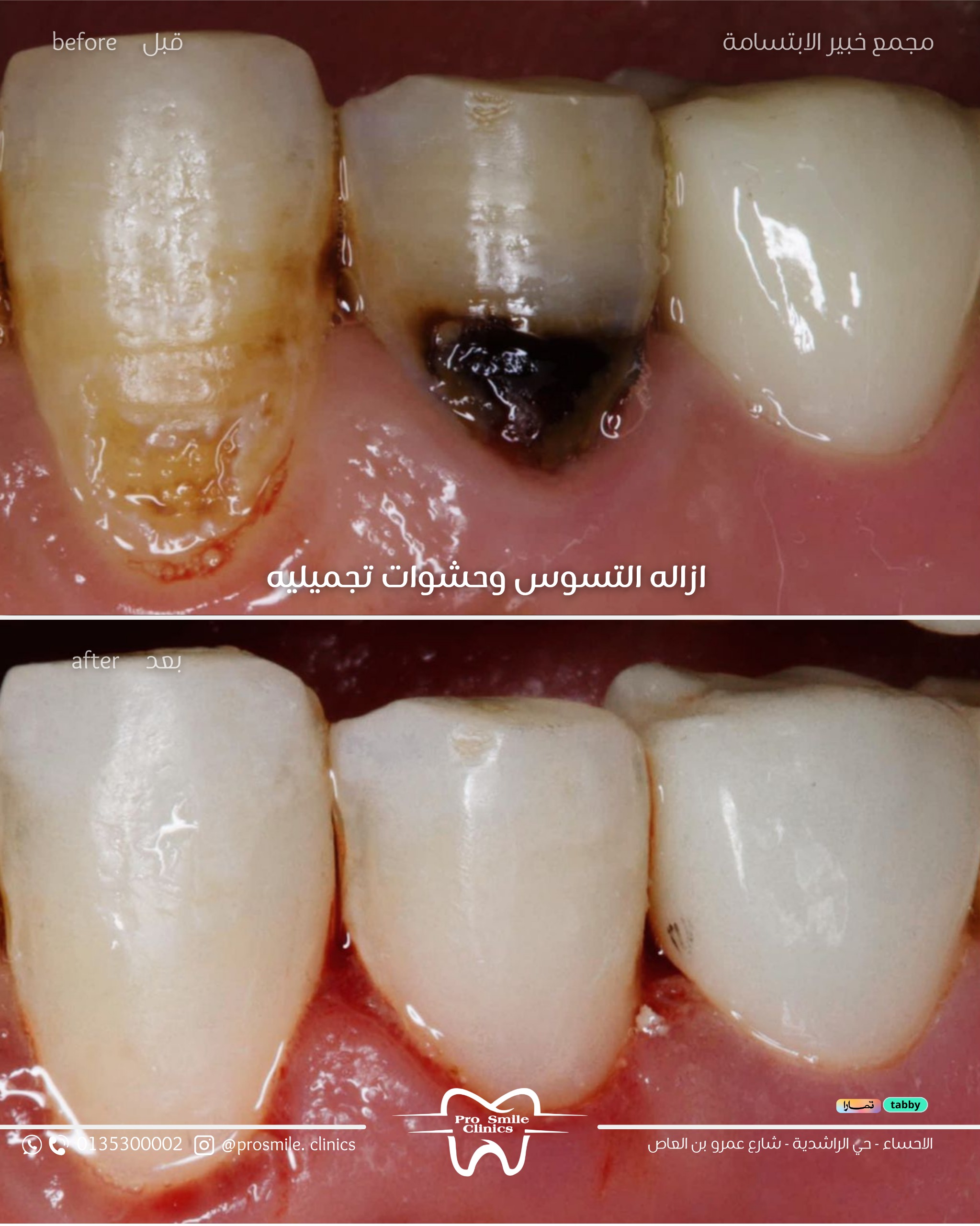 before after 4